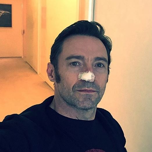 wolverine-hugh-jackman-cancer-de-peaux